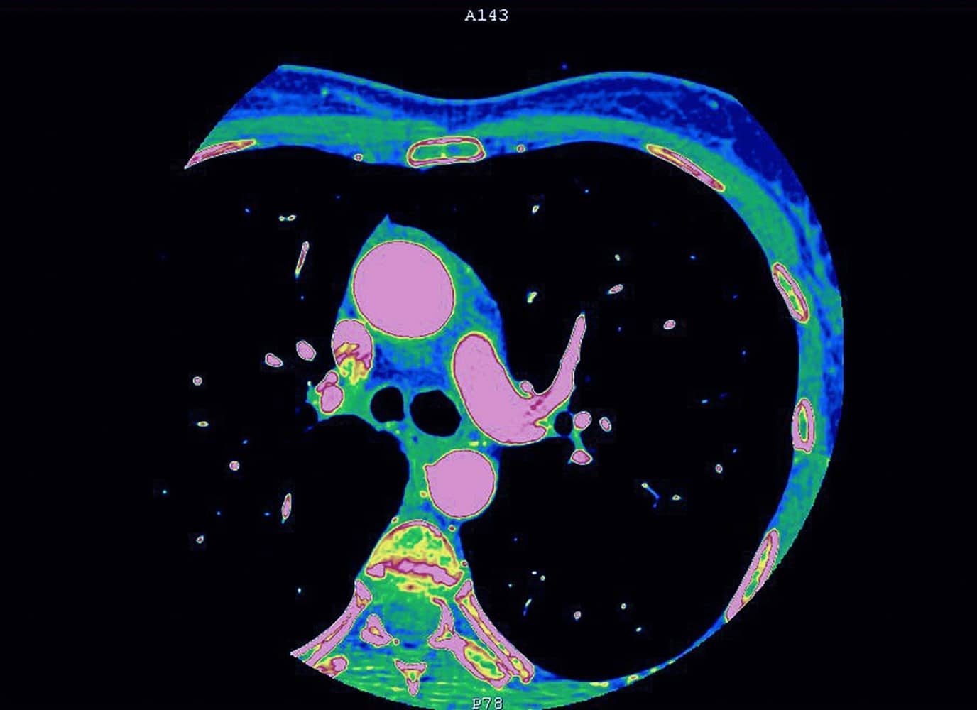 Image d Angioscanner - scanner vasculaire | Groupe Revelis